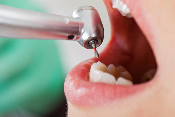Best Emergency Root Canal Treatment in Wink, TX